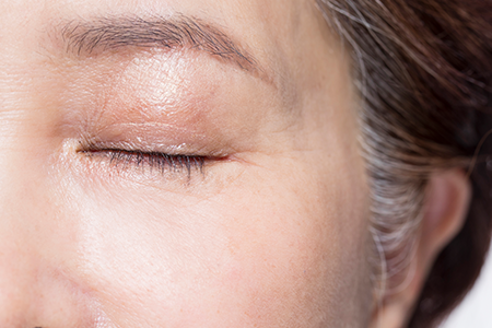 Wrinkle Botox Image