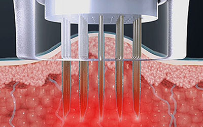 RF energy generation image