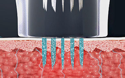 Coagulation zone image