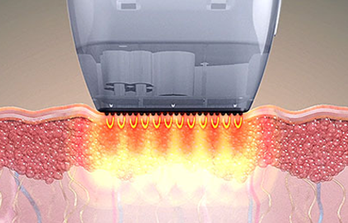 SFA TIP image