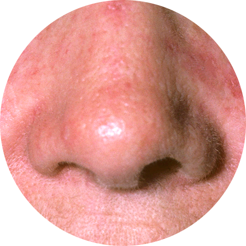 Red nose treatment image