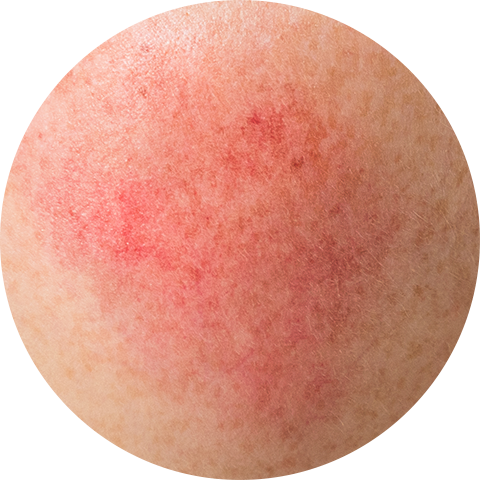 Facial redness and vascular treatment image