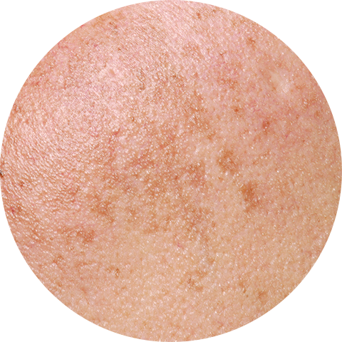 Melasma image