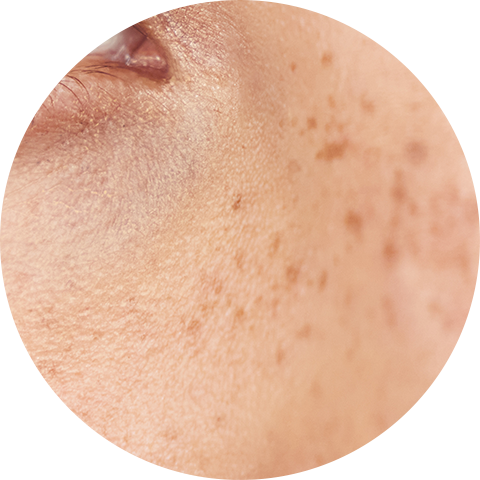 Freckles image