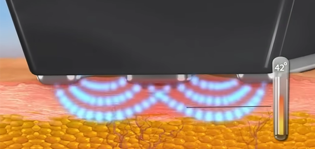 FORMA treatment image