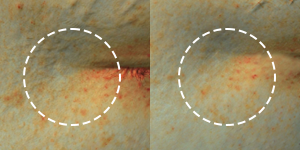 Comparison of pigmentation and blemishes before and after Elravie Re2O treatment