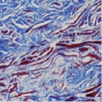 Collagen tissue 3 months after treatment