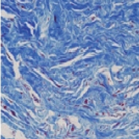 Collagen tissue 6 months after treatment