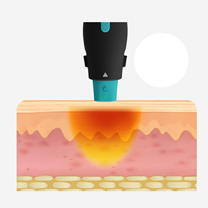 Oligio X G Mode dermal pre-heating principle